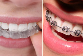 removable teeth braces and aligners