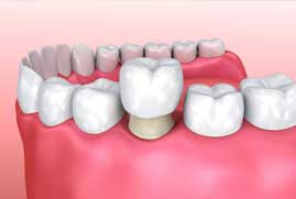 Dental Bridge and Crowns