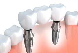 Dental implant