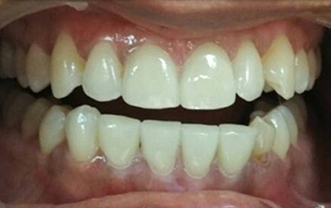 Teeth Polishing