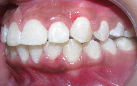 transparent braces