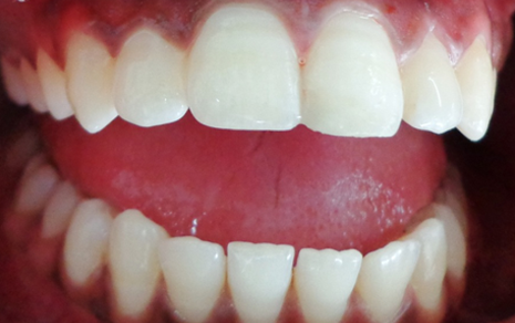 teeth scaling and polishing