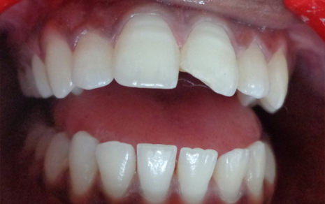 teeth scaling cost in india