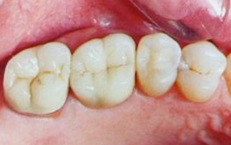 teeth cleaning cost in india
