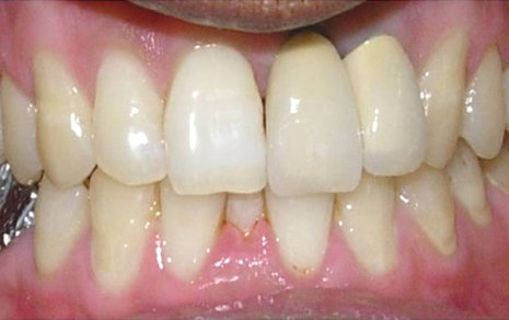 teeth scaling cost