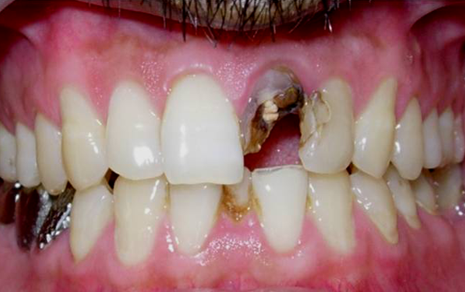 teeth scaling cost in india