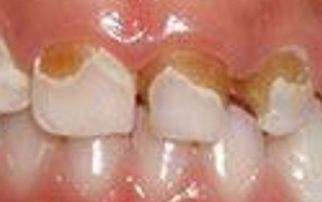 Kids Dental Care