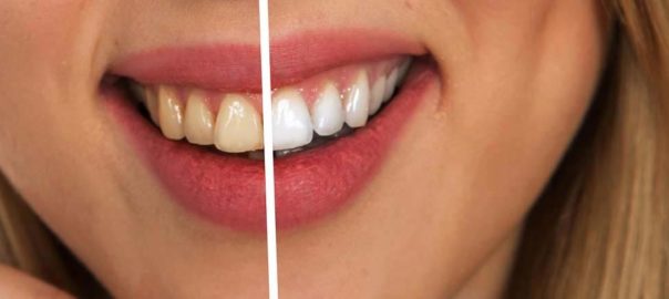 WHITER TEETH? LET’S KNOW ABOUT IT….
