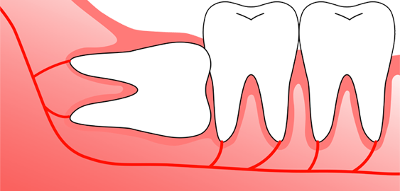 Wisdom Teeth