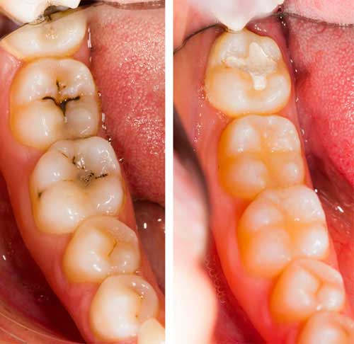 Dental Filling