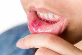 Mouth Ulcer Treatment