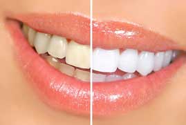 Teeth Whitening