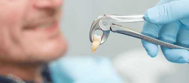 Tooth Extraction