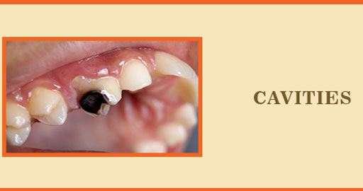 Cavities