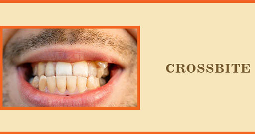 Crossbite