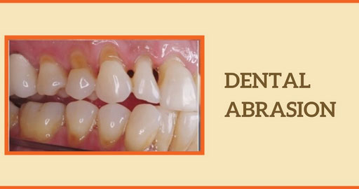Dental Abrasion