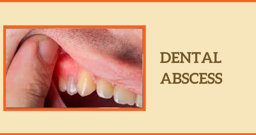 Dental Abscess