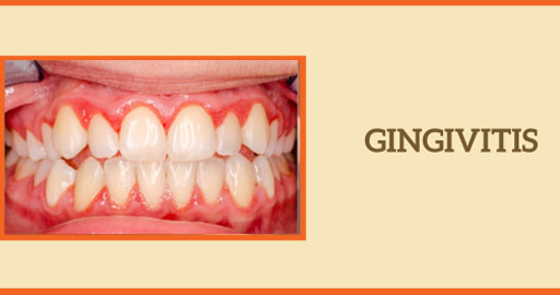Gingivitis