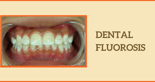 Dental Fluorosis