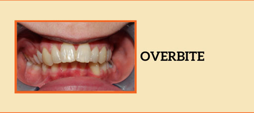 Overbite