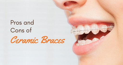 Ceramic Braces